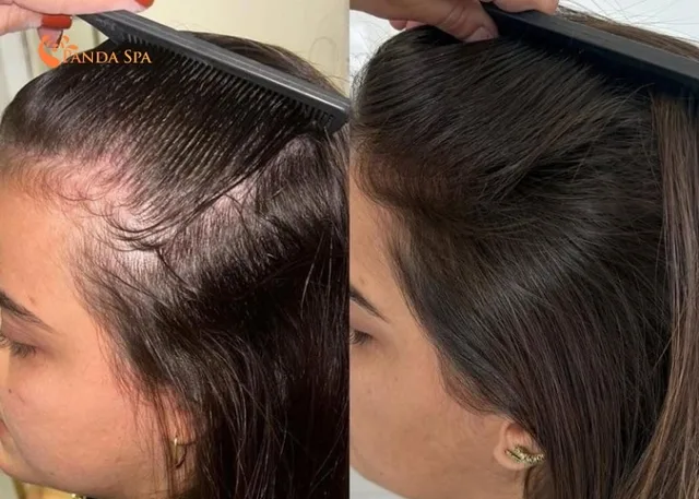 Gleditsia shampoo