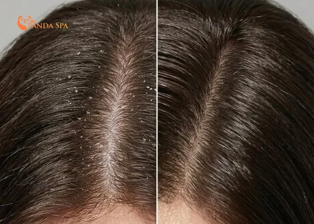 Gleditsia shampoo