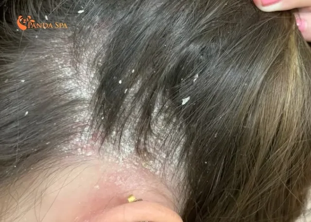 anti-hair loss shampoo