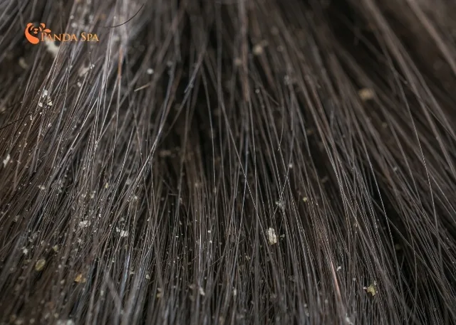 Top 8 effective anti-fungal dandruff shampoos for quick elimination