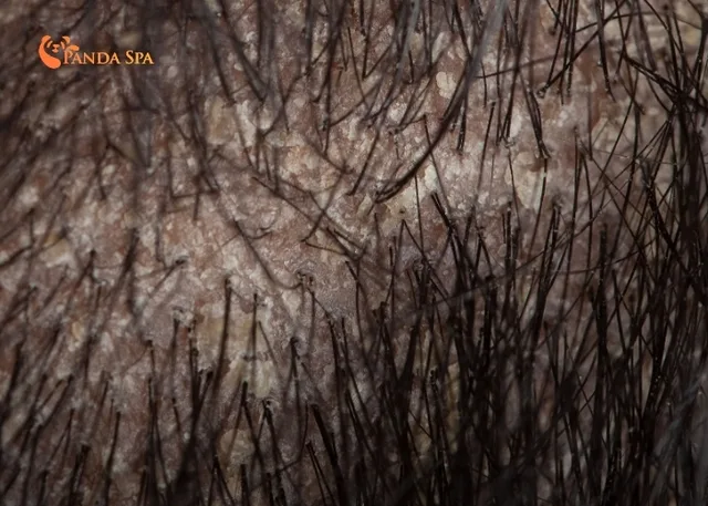 anti-dandruff shampoo