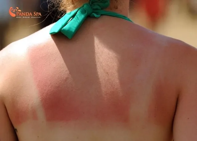 sunburn skin recovery da nang 2
