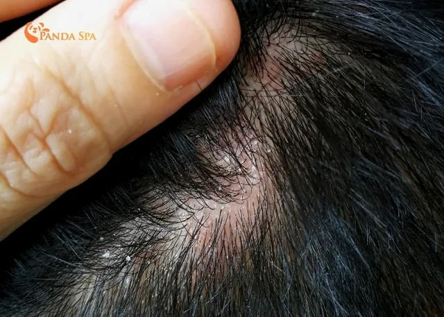 why do I still have dandruff after washing my hair