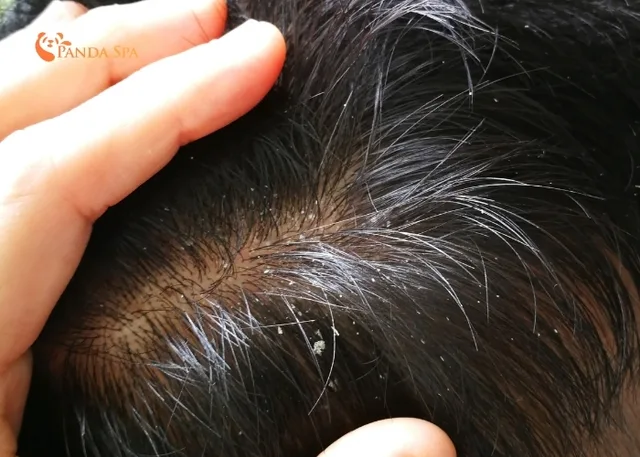 Why Do I Still Have Dandruff After Washing My Hair? Causes and Remedies